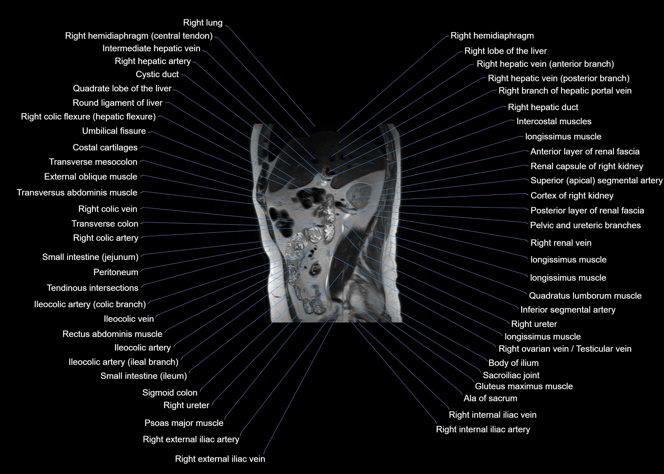 MRI abdomen sagittal cross sectional anatomy  radiology  image-img-00001-00028.webp